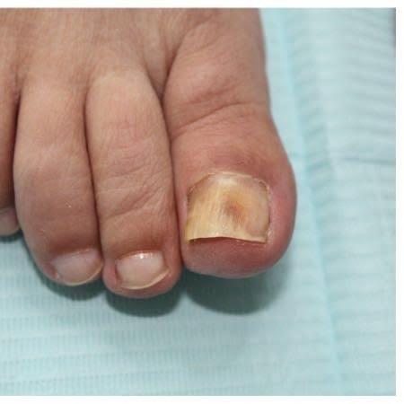 Voorbeeld 1 van een Mycose-behandeling bij Pedicure Halsteren
