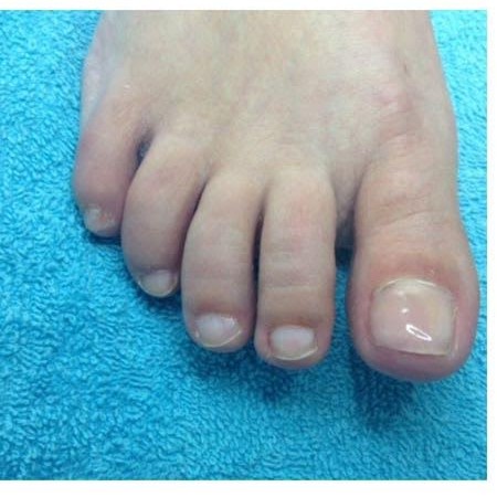 Voorbeeld 3 van een Mycose-behandeling bij Pedicure Halsteren