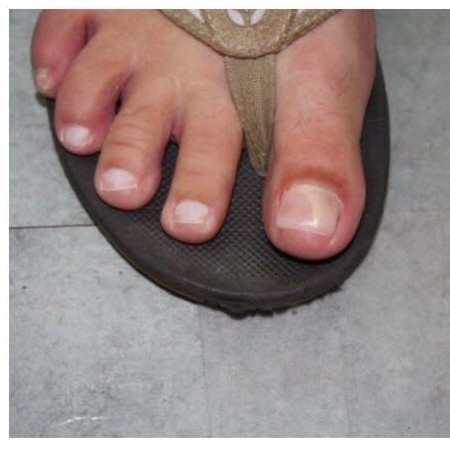 Voorbeeld 4 van een Mycose-behandeling bij Pedicure Halsteren